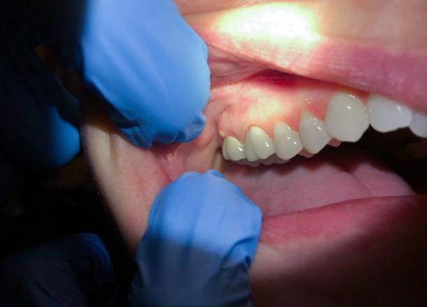 Best Dentist for Tooth Abscess  in Robertsde, AL